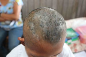 This child's parents can afford only to feed their child a diet of mostly white rice. Not having proper nutrition leads to a compromised immune system, which left this child vulnerable to opportunistic infections such as this fungal infection that kept him from sleeping or attending school. 
